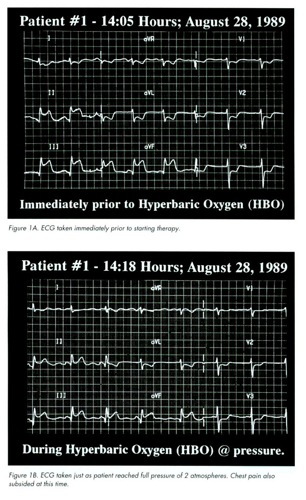 Effects of HBOT on Cardiology example #1